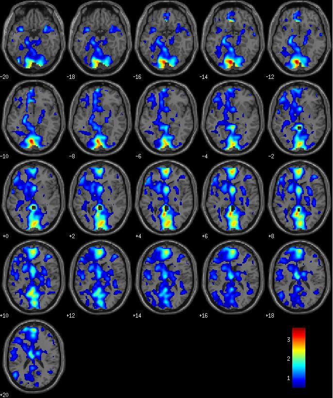 fMRI-scan-after-8-weeks-on-EyeQ