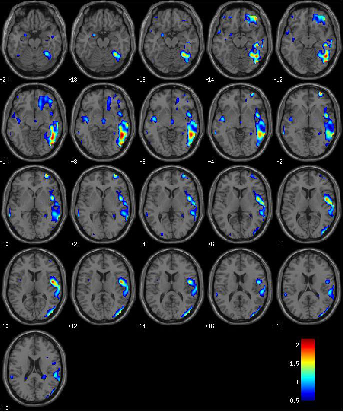 fMRI-scan-before-EyeQ